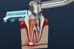 根管的治疗和补牙的区别是什么-啥时做根管