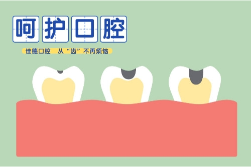 合肥根管的治疗