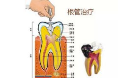 合肥做根管的治疗多少钱？--收费一览