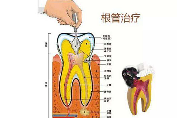 合肥做根管的治疗多少钱