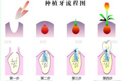 合肥种植牙齿需要多少钱？--种牙花费主要在这