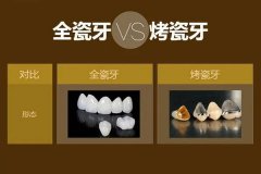 合肥全瓷牙多少钱一颗？--全瓷牙价格表一览