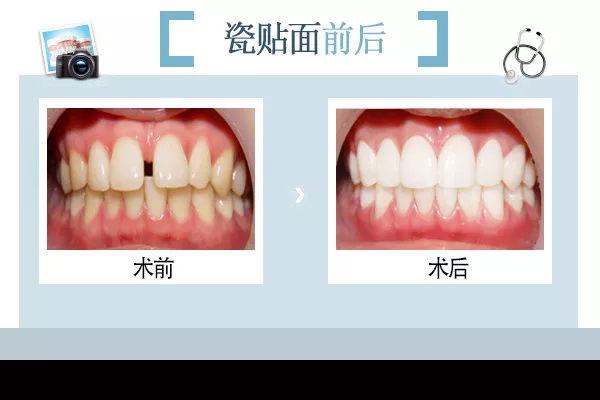 合肥牙齿贴面多少钱