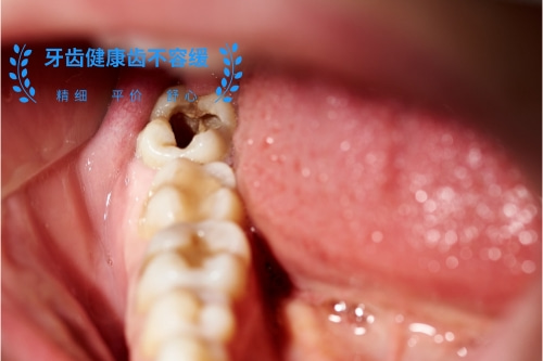 根管的治疗、合肥根管的治疗