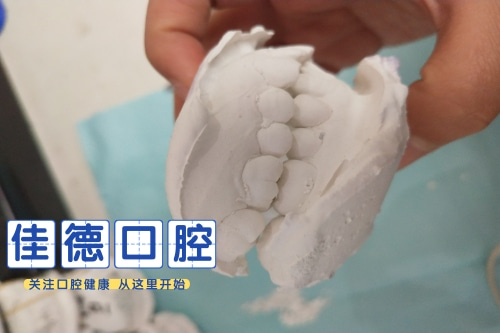 合肥种植牙