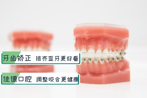 合肥牙齿矫正、合肥戴牙套