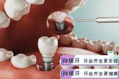 在合肥拔牙然后种植牙要多少钱-居然还能拔牙免费？