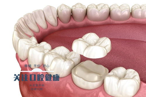 合肥牙齿贴面价格