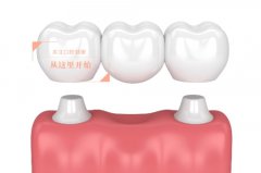 合肥哪里做牙冠便宜-医院选择要谨慎