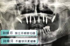合肥植半口牙多少钱-这家单颗低至4060元起？